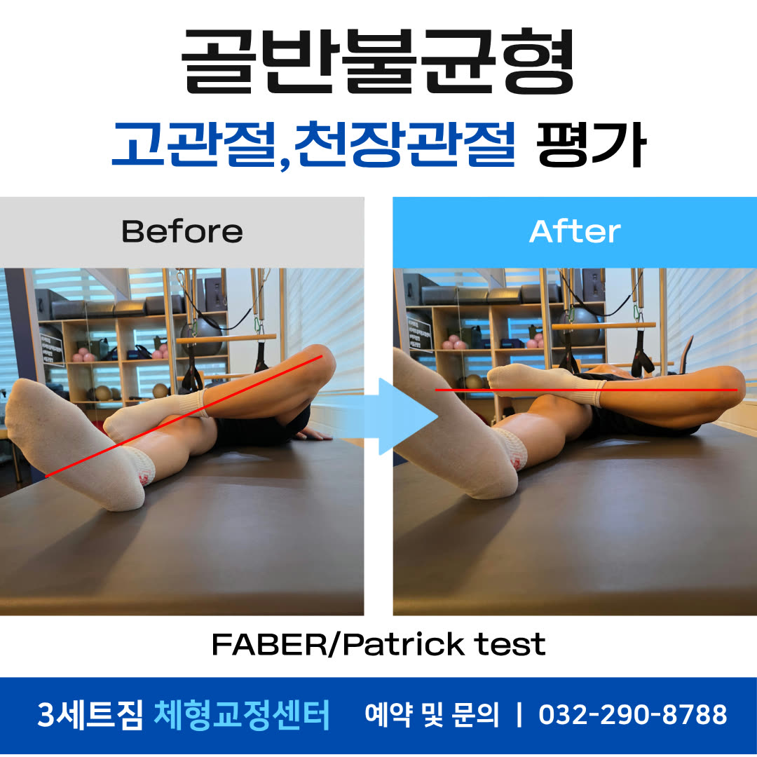 골반불균형 · 고관절·천장관절 평가(FABER test) 비포애프터