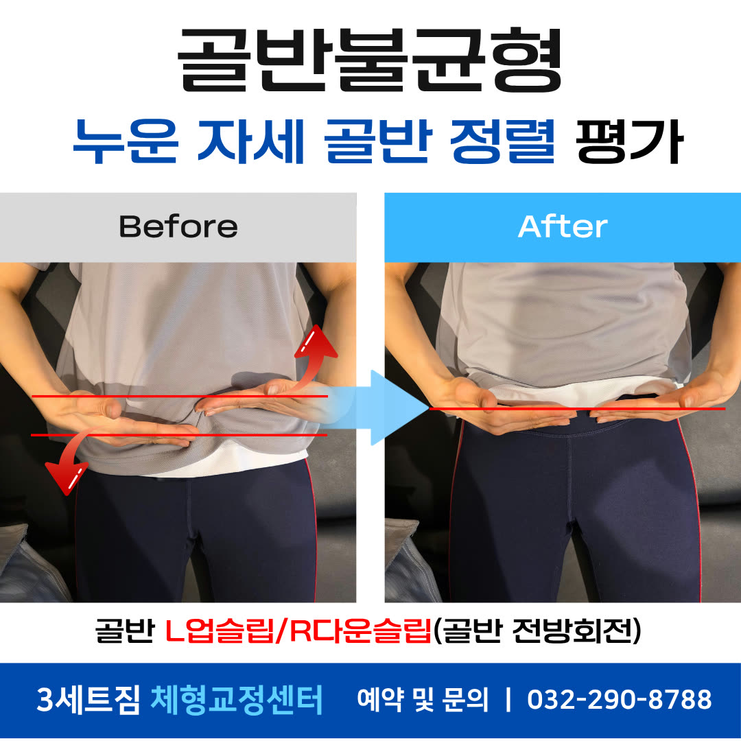 골반불균형 · 누운 자세 골반 정렬 평가 비포애프터