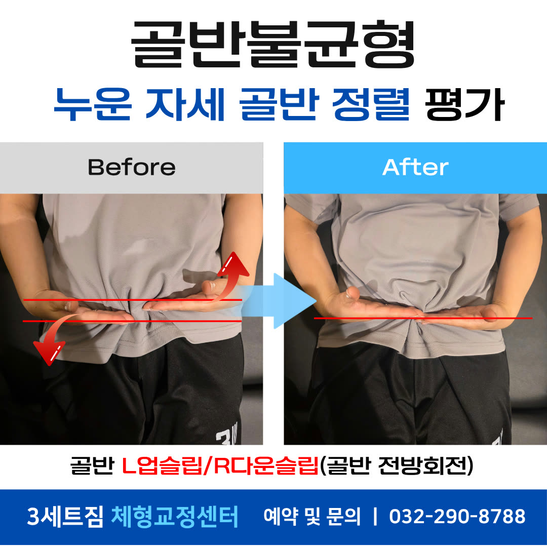 골반불균형 · 누운 자세 골반 정렬 평가 비포애프터