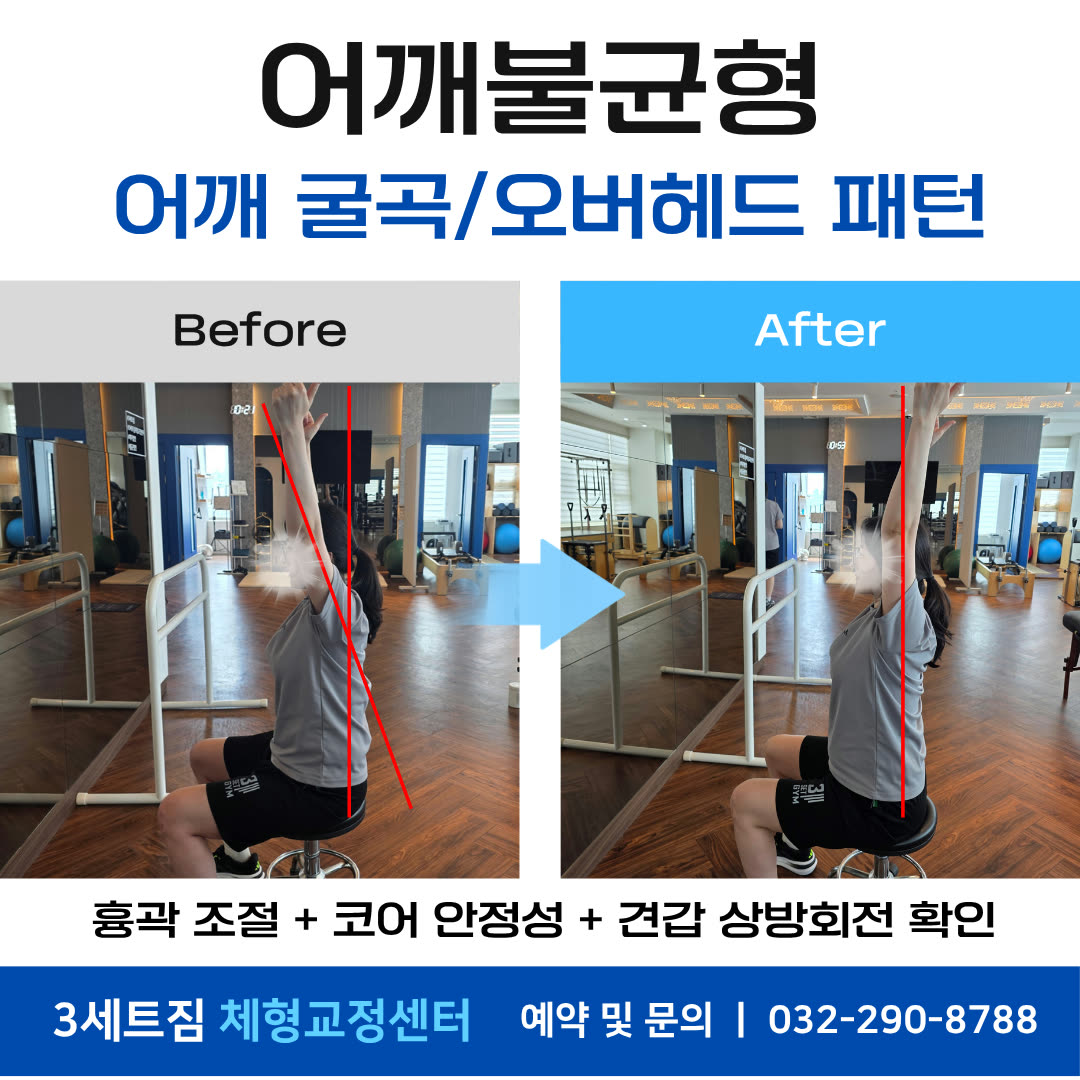 어깨불균형 · 어깨 굴곡/오버헤드 패턴 평가 비포애프터