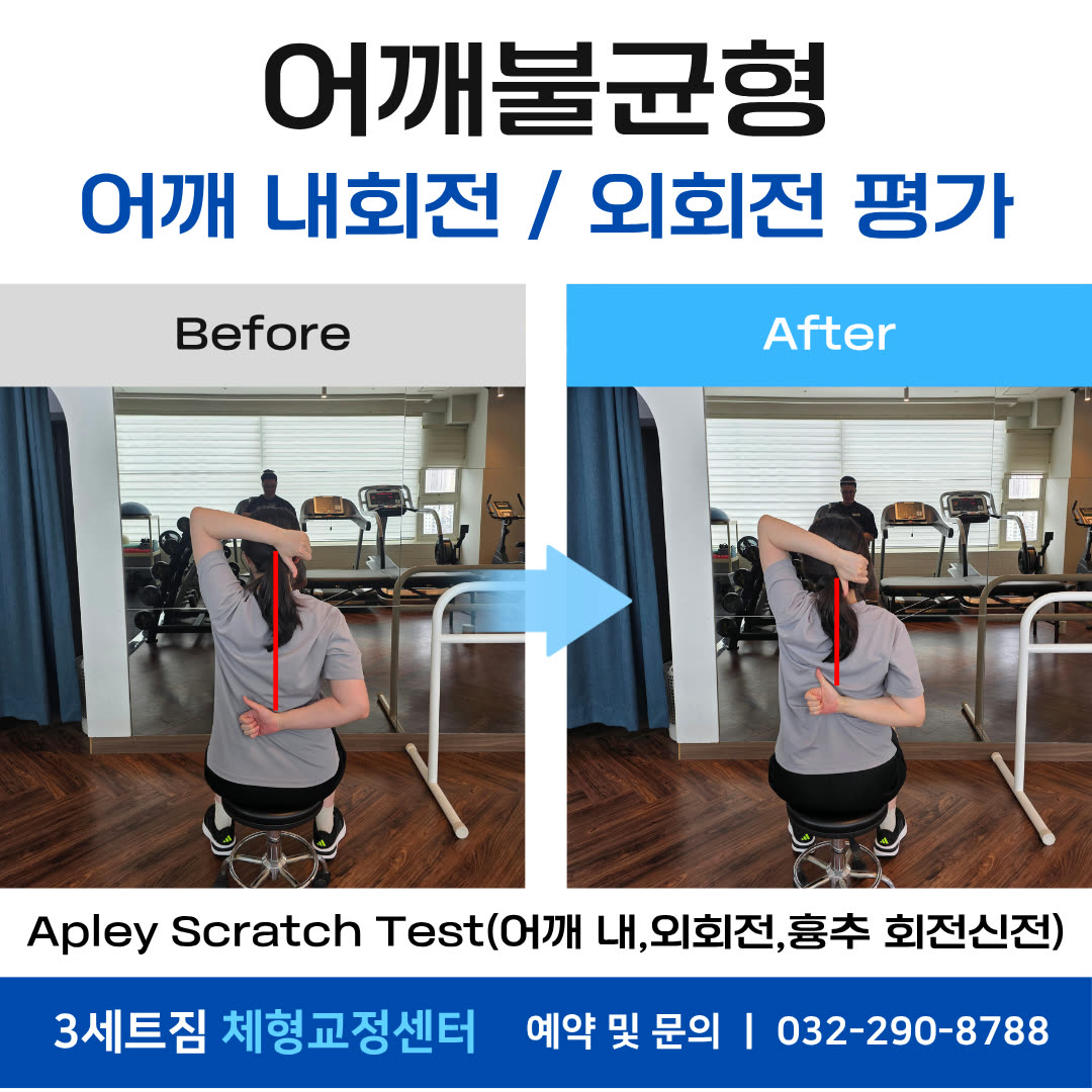 어깨불균형 · 어깨 내회전/외회전 평가(Apley Scratch Test) 비포애프터