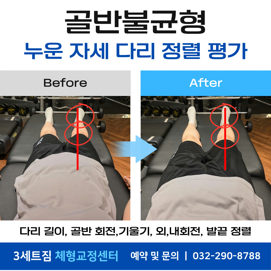 골반불균형 · 누운 자세 다리 정렬 평가 비포애프터