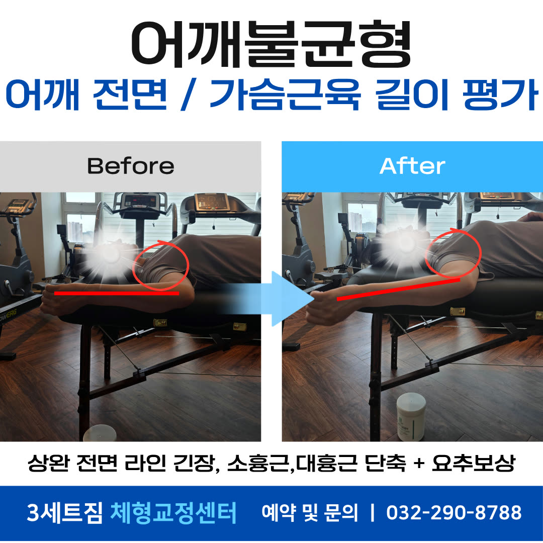 어깨불균형 · 어깨 전면·가슴근육 길이 평가 비포애프터
