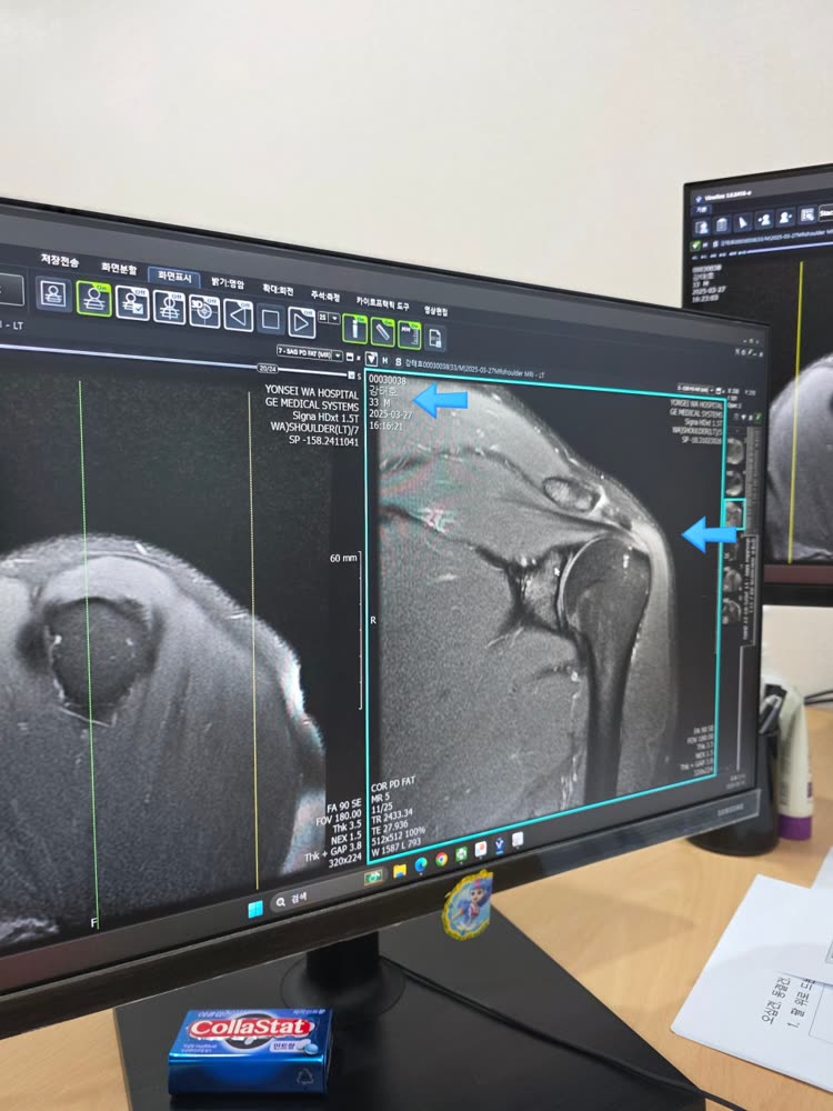 어깨 MRI 검사